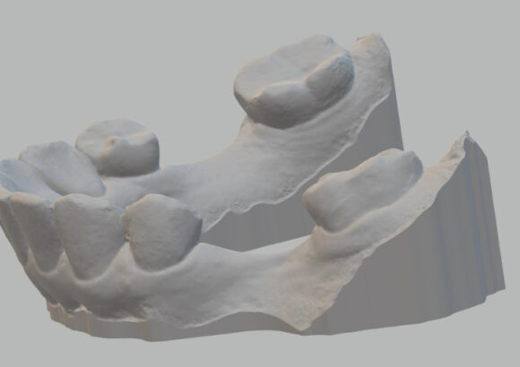 Escaneo para Guía Quirúrgica SDI