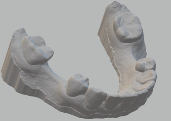 Escaneo para Guía Quirúrgica SDI