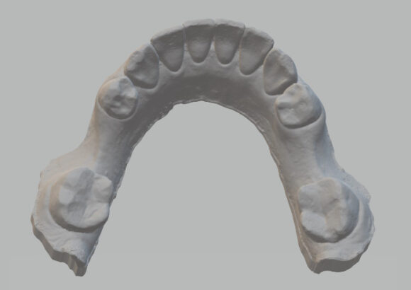 Escaneo para Guía Quirúrgica SDI