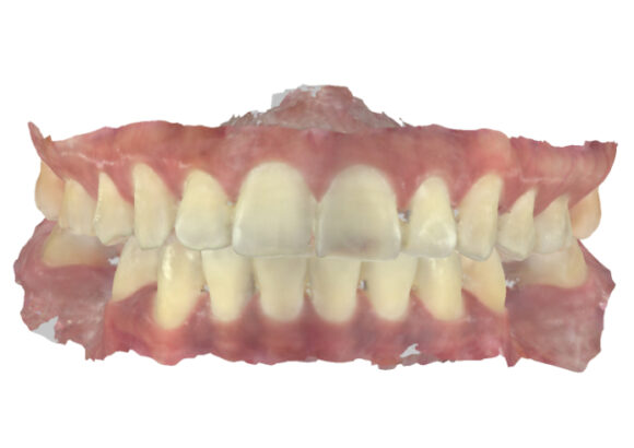 Escaneo para Guía Quirúrgica SDI