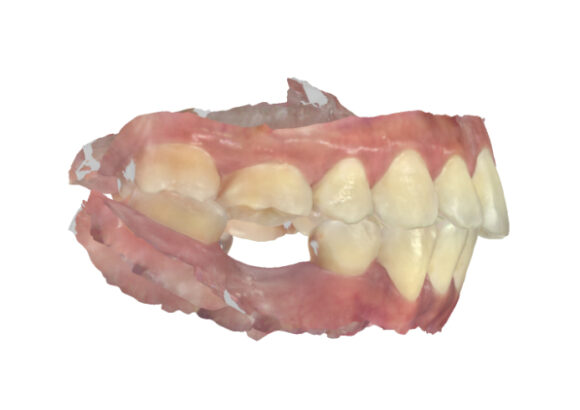 Escaneo para Guía Quirúrgica SDI