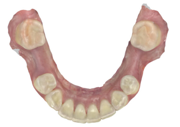 Escaneo para Guía Quirúrgica SDI