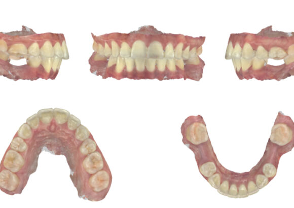 Tomografía para Guía Quirúrgica SDI