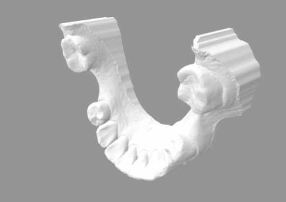 Escaneo para Guía Quirúrgica SDI