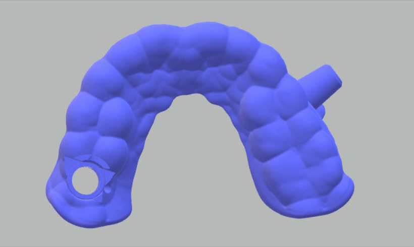 Guías quirúrgicas para implantología