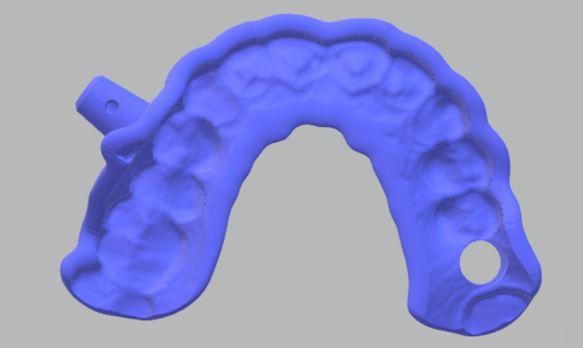 Guías quirúrgicas para implantología