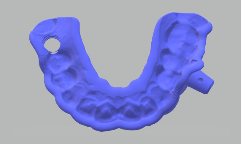 Guías quirúrgicas para implantología