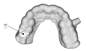 Guías quirúrgicas para implantología