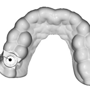 Guías quirúrgicas para implantología