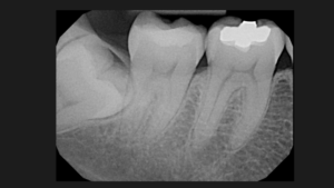 RAdiografia periapical
