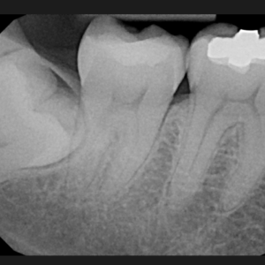 RAdiografia periapical