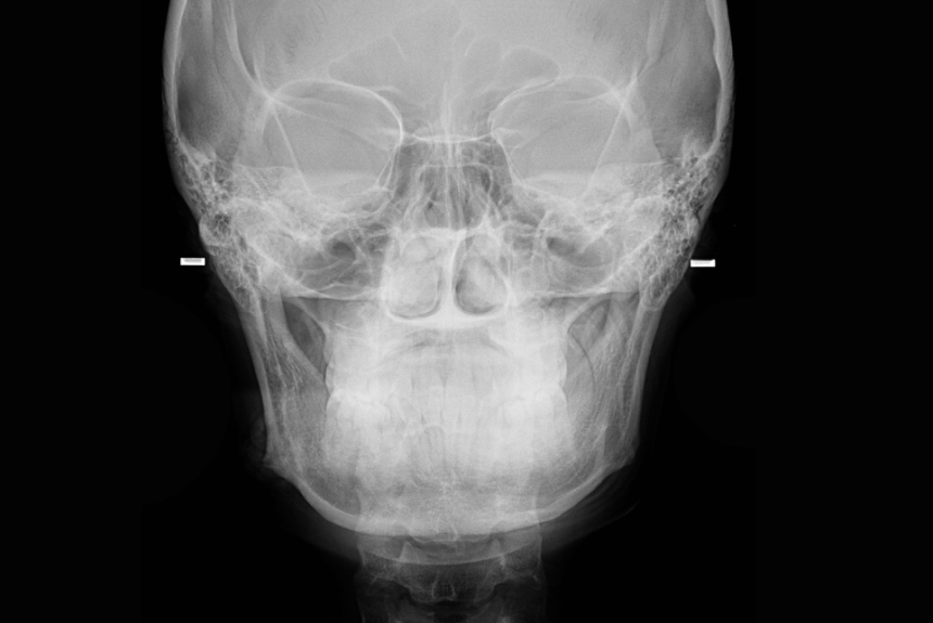 Radiografía de Caldwell en Studio Digital Imaging