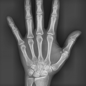 ¿Qué es una radiografía carpal?
