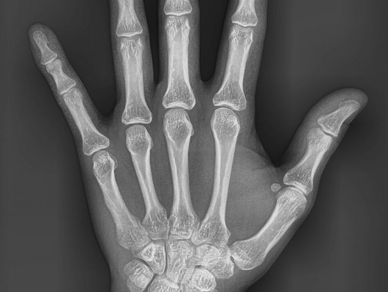 ¿Qué es una radiografía carpal?
